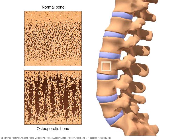 osteoporotic bone